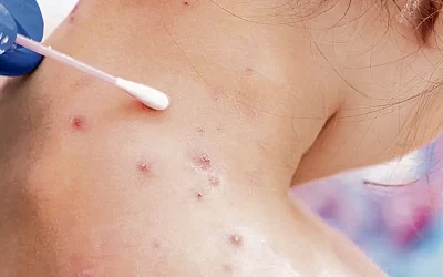 Viruela del mono en Cusco: confirman segundo caso de la enfermedad